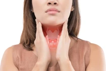 Viêm họng mãn tính có tiến triển thành ung thư?