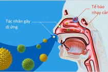 Bác sĩ chỉ rõ dấu hiệu viêm mũi tránh nhầm cảm cúm và cách chữa