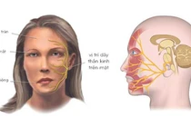 Cách điều trị liệt dây thần kinh số VII ngoại biên bằng y học cổ truyền