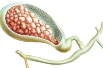 Bác sĩ chỉ thói quen tưởng vô hại nhưng dễ gây sỏi mật, polyp mật