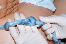 Dây rốn thắt nút là mối nguy hiểm“đe dọa hàng triệu mẹ bầu