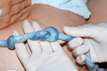 Dây rốn thắt nút là mối nguy hiểm“đe dọa hàng triệu mẹ bầu