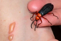 Tê bì đầu lưỡi, yếu cơ tứ chi... sau ăn sâu ban miêu: Phòng tránh sao?