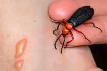 Tê bì đầu lưỡi, yếu cơ tứ chi... sau ăn sâu ban miêu: Phòng tránh sao?