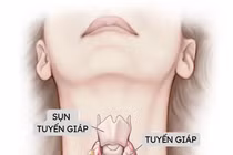 Có những dấu hiệu này, nghĩ ngay tới bệnh lý tuyến giáp