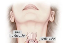 Có những dấu hiệu này, nghĩ ngay tới bệnh lý tuyến giáp
