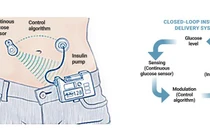 Tụy nhân tạo: Sản phẩm trí tuệ kết nối từ những người bệnh đái tháo đường