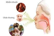 Bài thuốc chữa viêm mũi xoang, dị ứng