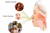 Bài thuốc chữa viêm mũi xoang, dị ứng