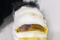 Laptop phát nổ, bé trai 08 tuổi bị bỏng nặng: phòng tránh ra sao