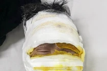 Laptop phát nổ, bé trai 08 tuổi bị bỏng nặng: phòng tránh ra sao