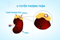 Tăng huyết áp, hạ kali máu tái diễn, đi khám phát hiện u tuyến thượng thận