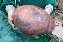 Tưởng tăng cân do tẩm bổ không ngờ... u ác buồng trứng khổng lồ