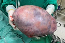 Tưởng tăng cân do tẩm bổ không ngờ... u ác buồng trứng khổng lồ