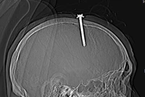 Bị trầm cảm, quý ông 63 tuổi đóng đinh sắt 5 cm vào đầu