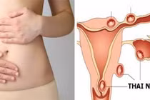 Đau bụng ở phụ nữ... có thể dấu hiệu chửa ngoài tử cung