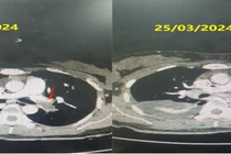 Cứu thành công sản phụ ngừng tim do thuyên tắc phổi cấp