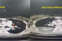 Cứu thành công sản phụ ngừng tim do thuyên tắc phổi cấp