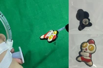 Nuốt hình ngộ nghĩnh gắn dép bé 17 tháng nội soi gây mê lấy dị vật