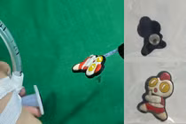 Nuốt hình ngộ nghĩnh gắn dép bé 17 tháng nội soi gây mê lấy dị vật