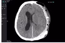 Cứu sống bệnh nhân bị tai nạn chấn thương sọ não, tiên lượng rất nặng