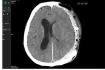 Cứu sống bệnh nhân bị tai nạn chấn thương sọ não, tiên lượng rất nặng