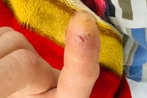 Sau vài phút bị cu li cắn, quý ông 31 tuổi đã sốc phản vệ