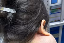 Suýt mất mạng vì 14 năm không điều trị u “khổng lồ” trên mặt