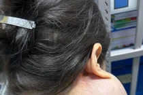 Suýt mất mạng vì 14 năm không điều trị u “khổng lồ” trên mặt