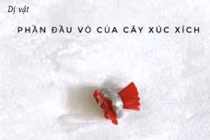 Lấy dị vật âm đạo cho bé gái 5 tuổi tránh vô sinh