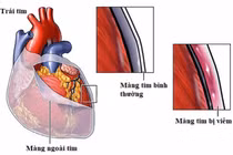 Mệt mỏi kéo dài, bệnh nhân nam 47 tuổi không ngờ viêm nội tâm mạc