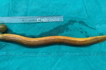  Thanh niên 31 tuổi suýt "mất mạng" vì nhét con lươn 65cm vào hậu môn