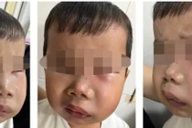 Trẻ sâu răng cẩn thận biến chứng viêm tủy răng gây nhiễm trùng máu