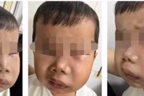 Trẻ sâu răng cẩn thận biến chứng viêm tủy răng gây nhiễm trùng máu