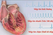 Nhịp tim chậm có nguy hiểm?