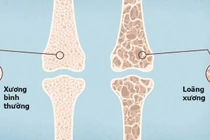 3,5 triệu người Việt loãng xương: hệ lụy của gãy xương ở người già