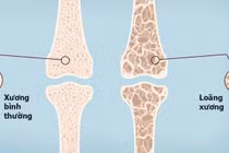 3,5 triệu người Việt loãng xương: hệ lụy của gãy xương ở người già