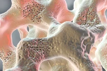 Loãng xương “kẻ giấu mặt gây nguy hiểm”, phát hiện thế nào?