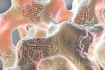 Loãng xương “kẻ giấu mặt gây nguy hiểm”, phát hiện thế nào?