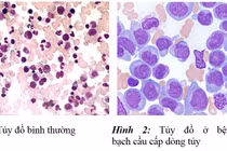 Biểu hiện tủy đồ của bệnh máu trắng 