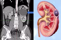 Nang đơn thận có nguy hiểm?