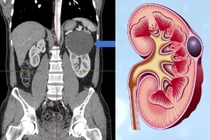 Nang đơn thận có nguy hiểm?