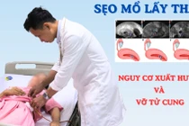 Thai bám ở sẹo mổ lấy thai, nguy cơ xuất huyết và vỡ tử cung