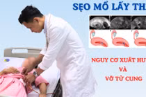 Thai bám ở sẹo mổ lấy thai, nguy cơ xuất huyết và vỡ tử cung