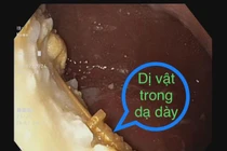 Lấy thanh kiếm trong dạ dày trẻ 33 tháng, cảnh báo nuốt dị vật ở trẻ