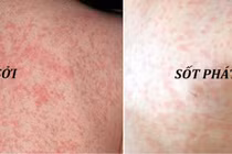 Sởi tăng 8 lần, ho gà tăng 25 lần: Bộ Y tế chỉ đạo phòng dịch