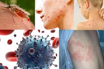 Sởi, ho gà, thủy đậu tăng, Bộ Y tế chỉ đạo phòng chống dịch dịp 30/4-1/5