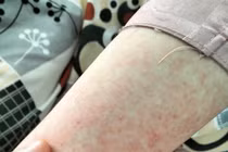 Tự mua thuốc chữa long đờm, bé 13 tuổi bị nổi mụn mủ toàn thân 