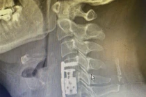 Thay đốt sống cổ nhân tạo cho người thoát vị cột sống cổ 10 năm