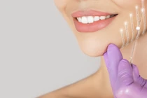 Cách cấy chỉ làm đẹp an toàn, không gây biến chứng